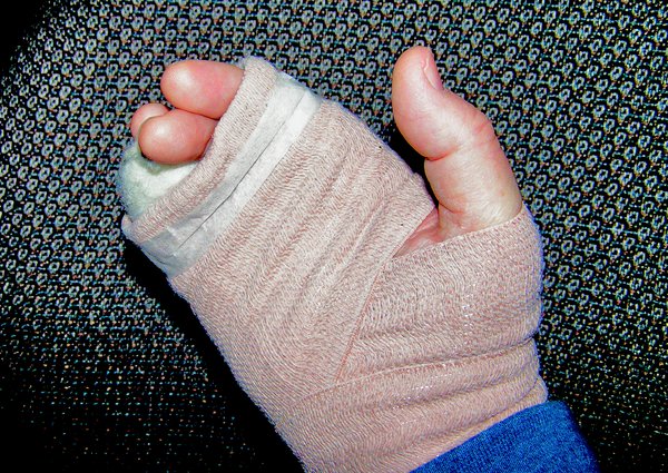 broken hand, broken wrist, broken finger, wrist fracture, hand fracture, finger fracture, Memphis