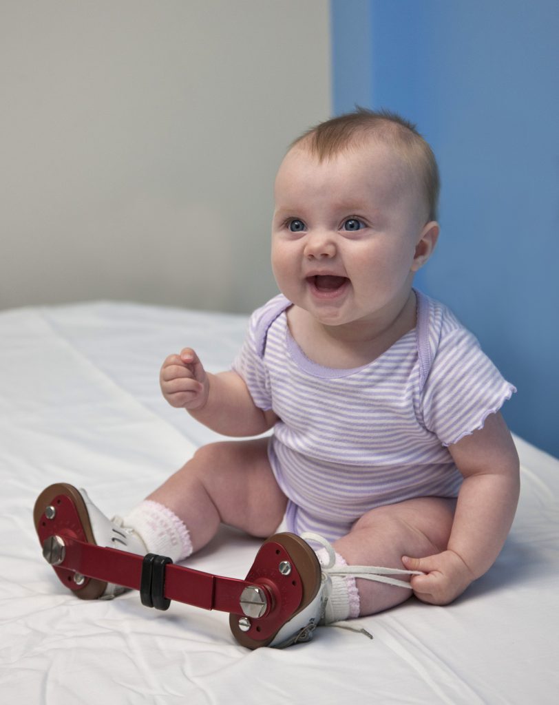 Clubfoot Talipes Equinovarus Campbell Clinic Orthopaedics clubfoot-talipes-equinovarus-campbell-clinic-orthopaedics