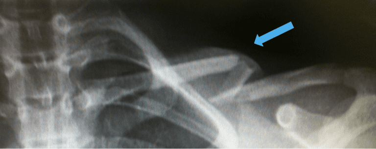 Clavicle Fractures (Broken Collarbone) - Campbell Clinic Orthopaedics
