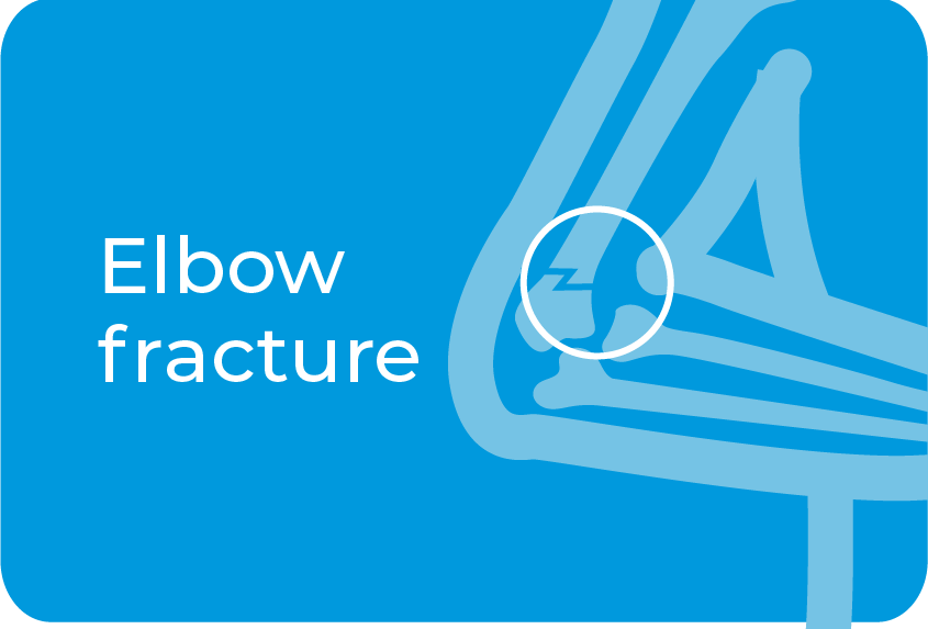 Elbow fracture