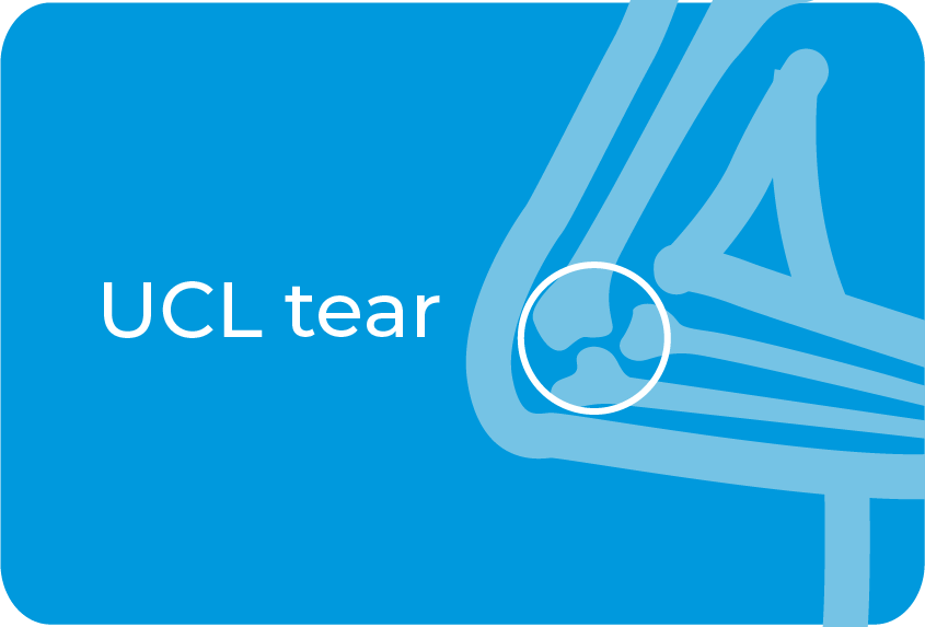 UCL tear