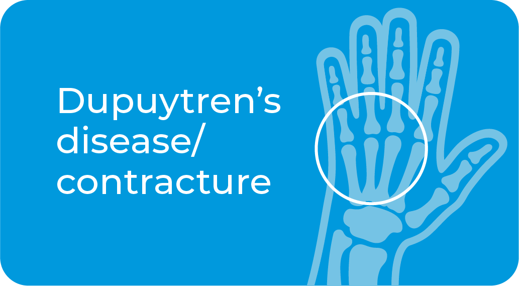 Dupuytren's disease/contracture