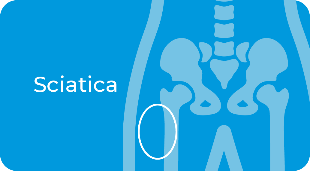 Sciatica