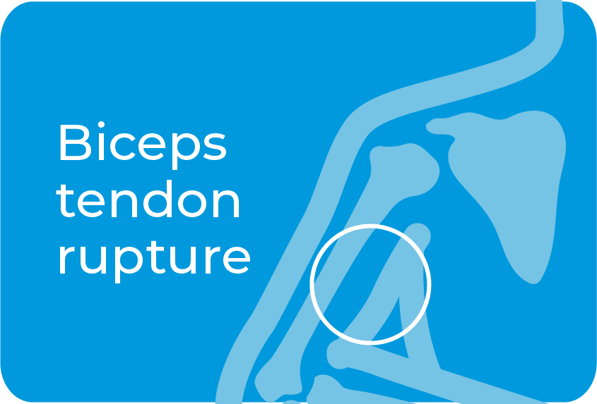 Biceps tendon rupture