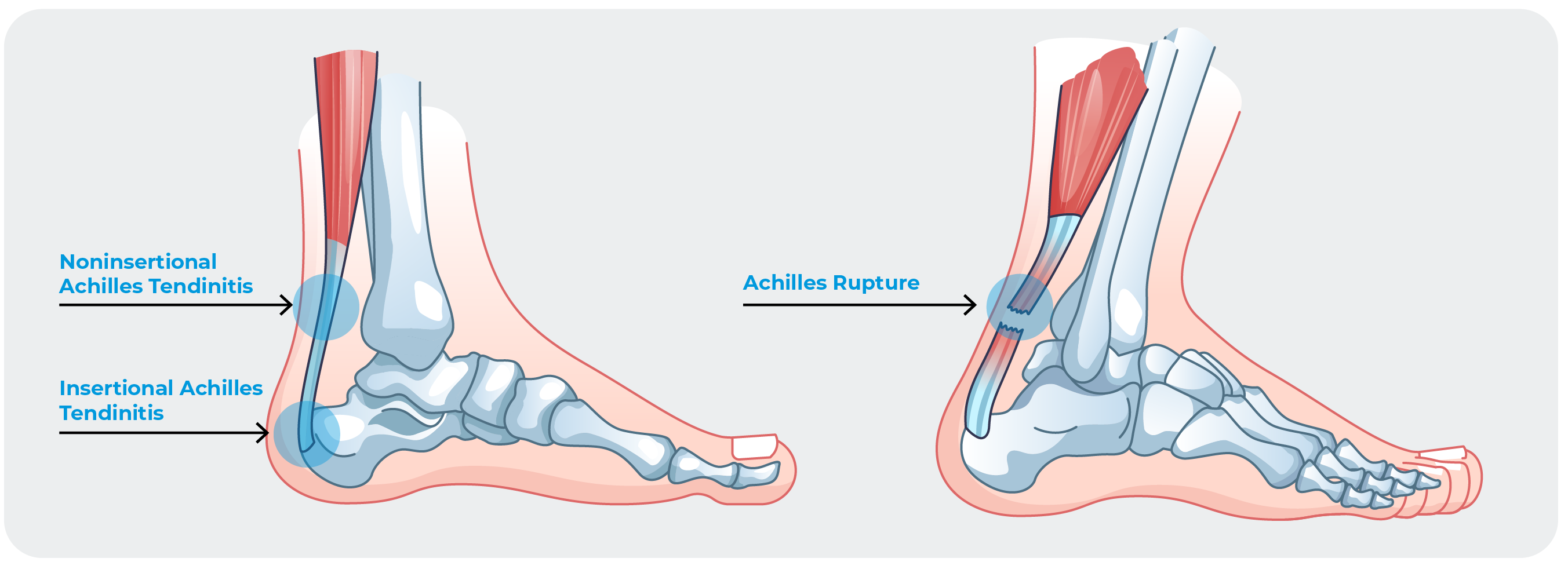 Sharp pain in the heel? These could be the reasons!