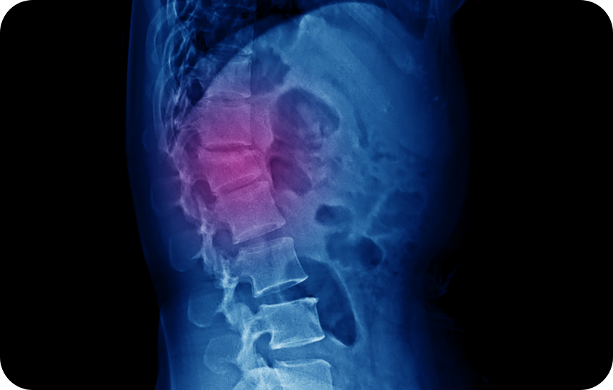 Kyphoplasty xray