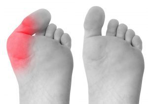 Highlight of a bunion next to a normal foot