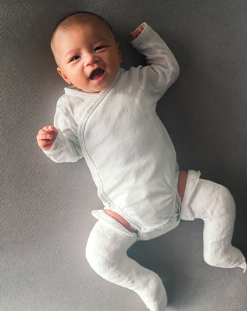 A baby in casts for clubfeet