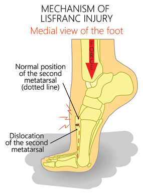 Mechanism of Lisfranc Injury